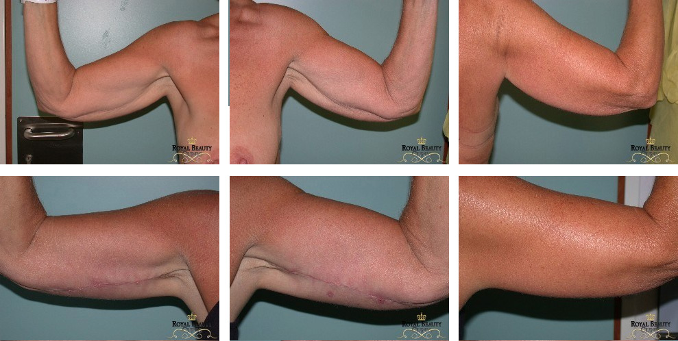 voor en na foto's Armlifting